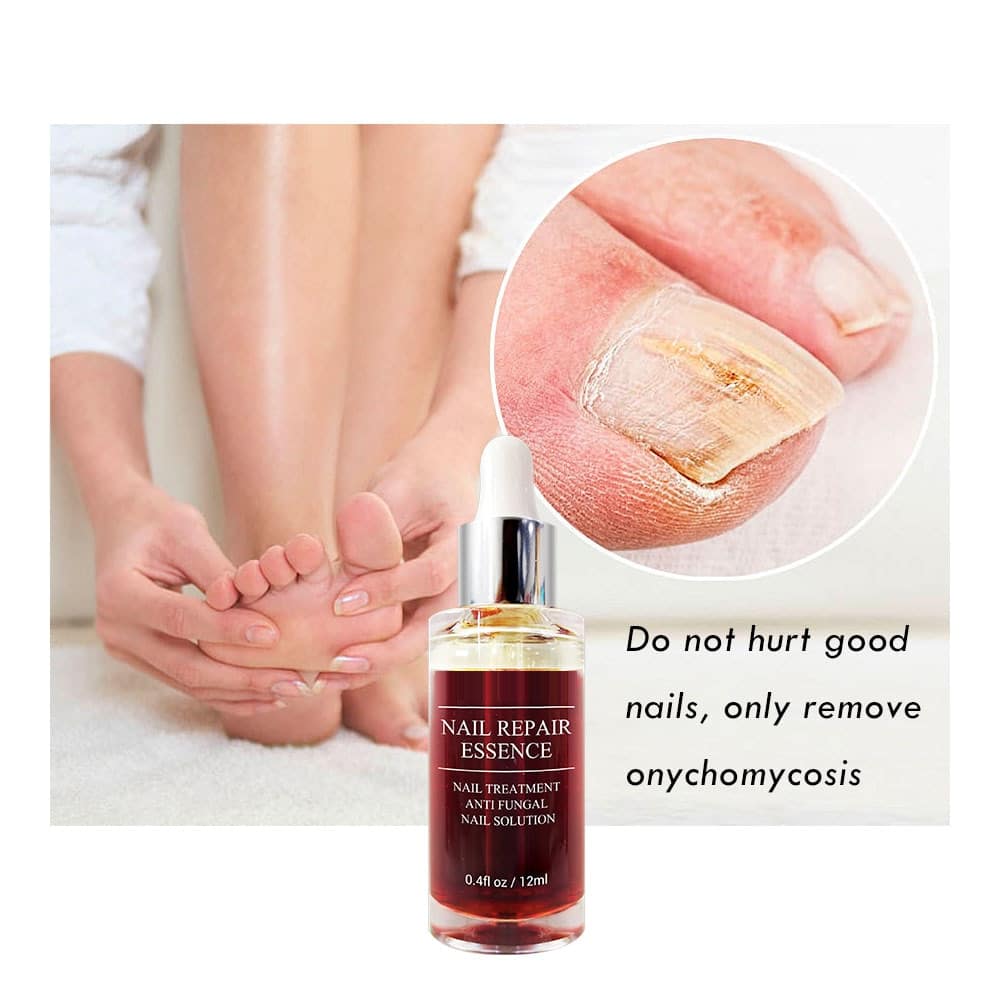 LANBENA-Sérum para reparación de uñas, tratamiento para el cuidado de hongos en las uñas de los pies, Gel antiinfección, paroniquia y onicomicosis
